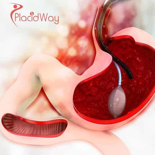 Non-Surgical Gastric Balloon Treatment in Mexico for U.S. Patients